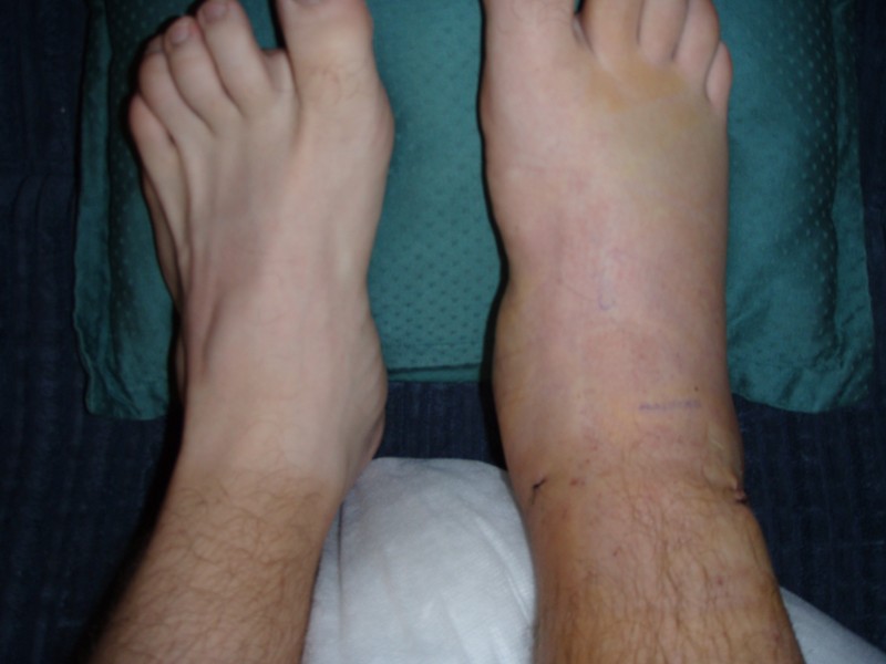 My Effed up ankle compared to my normal ankle