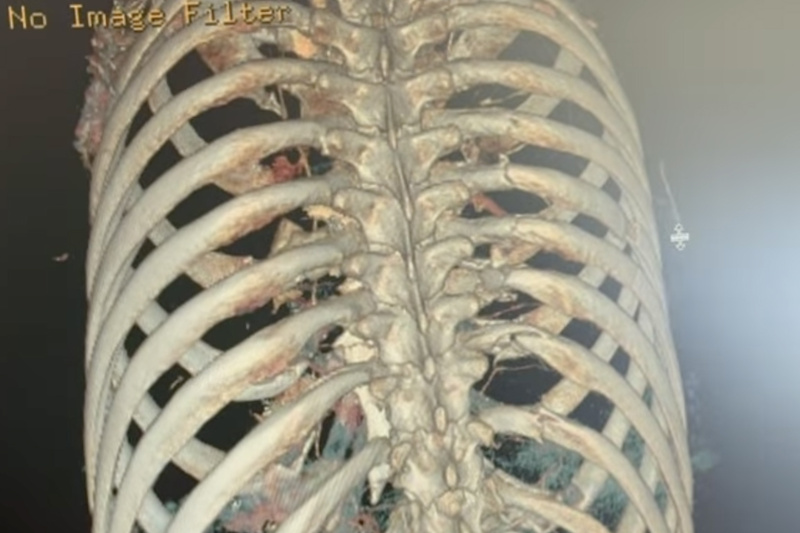 Cam Zink Recovering From Six Broken Ribs & Collapsed Lung After Rampage ...