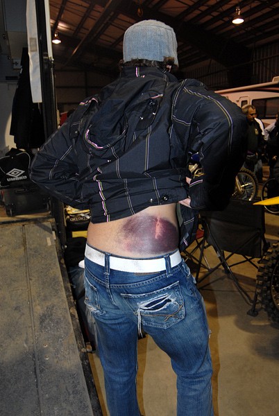 nov 16 and 17 race days at the track this guy in the 450 class came up short on the double and got this nasty bruise