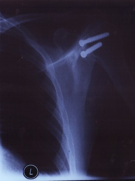 Two screws in shoulder after open reduction internal fixation of left humerus.  Broken and dislocated following hit-and-run incident on road bike May 2008.