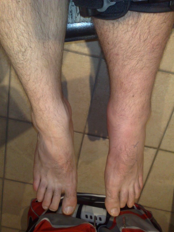 October 2008: Showing swelling in ankle from knee surgery.