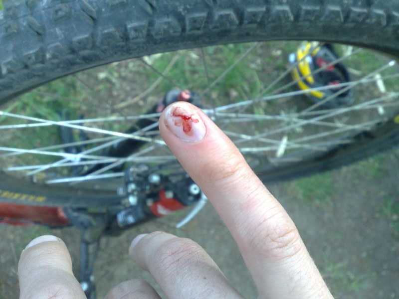 June 2008: Little finger caught in spinning brake rotor.  Fortunately caught nail, other side and might've lost it.