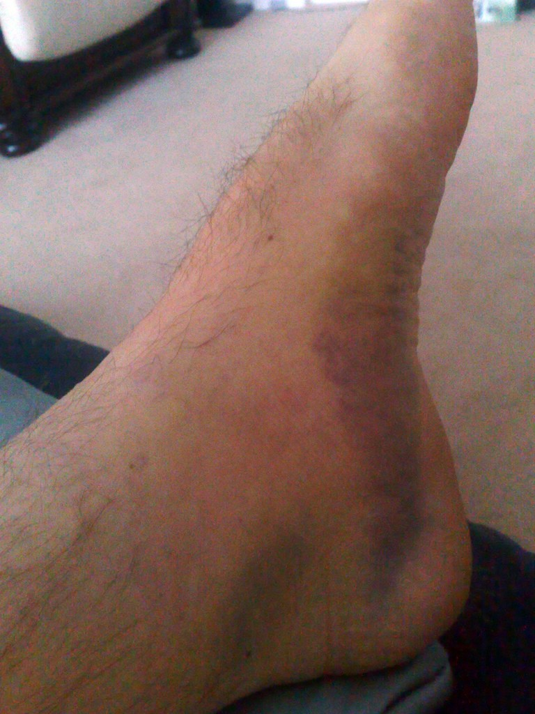 October 2008: Swelling and bruising in the ankle from knee surgery and calf tear.