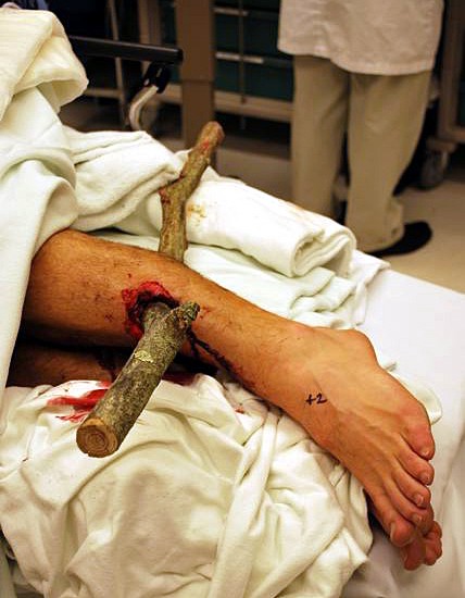 not me just found this on the internet

http://www.ride-strong.com/freak-bike-accident-view-with-caution/