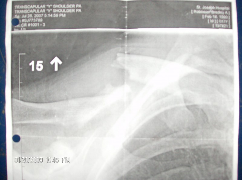 old pic of my collar bone, broken and fractured in 2 places