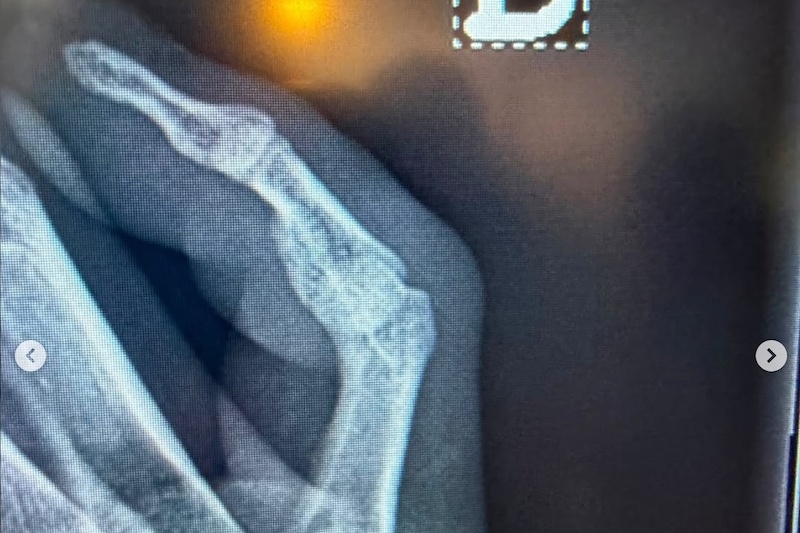 Myriam Nicole Breaks and Dislocates Finger at the Andorra DH World Cup