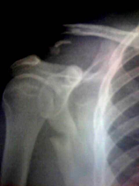 Busted up.

Severely broken clavical and scapula