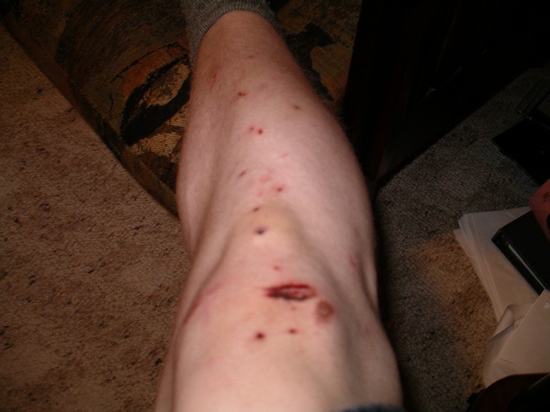 My gnarred leg from learning no foot cans.