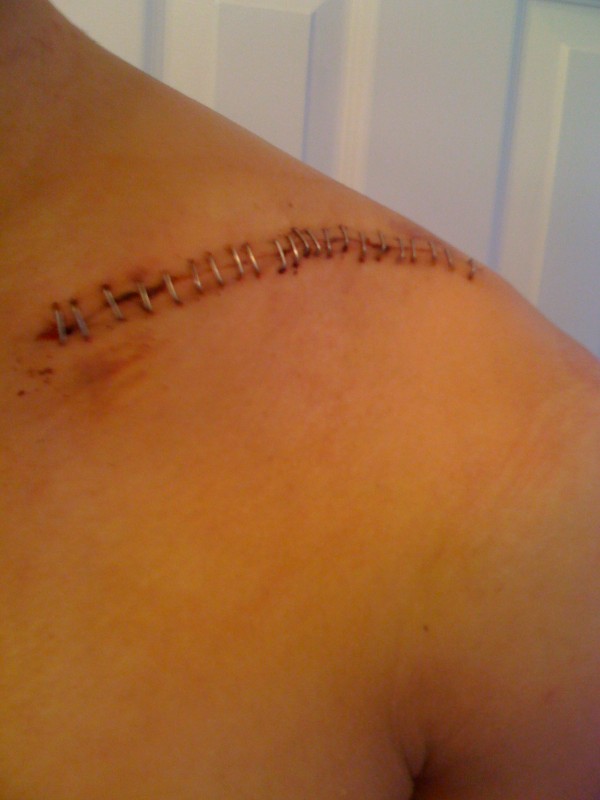 a plate put in to attach my collar bone after i snapped it got 23 staples