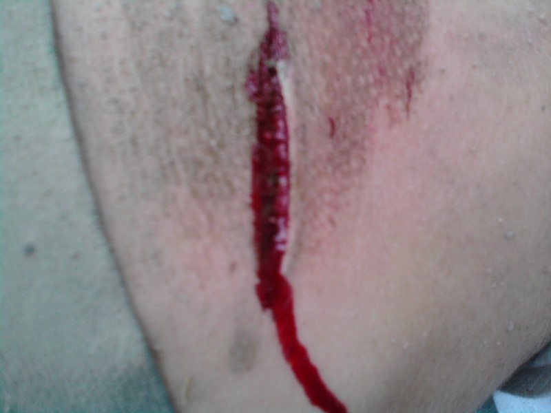 Wash out on the burm!!! 10 stitches!!!!!