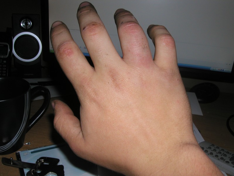broken hand... all swollen and such