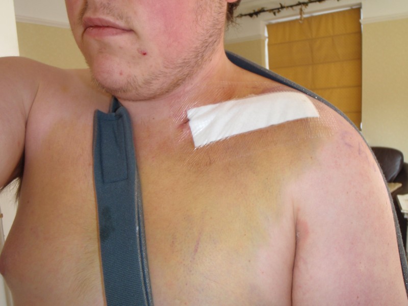 shattered collar bone 
had a bone graft and pinned