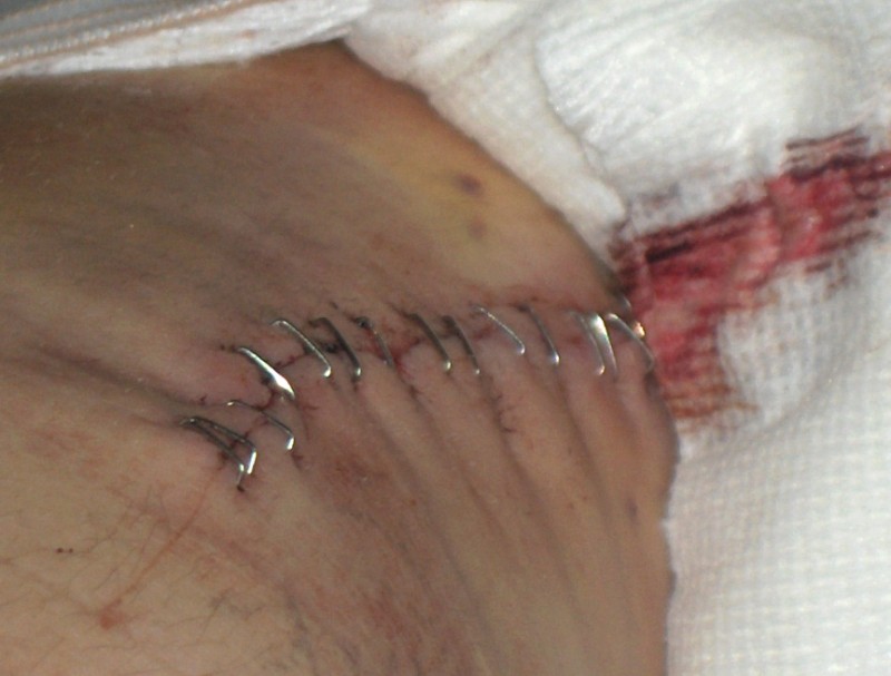 from outside in 3.5 inch incision,16 staples,12 suechers to hold tendon to bone fragment that is being held on with 2 screws