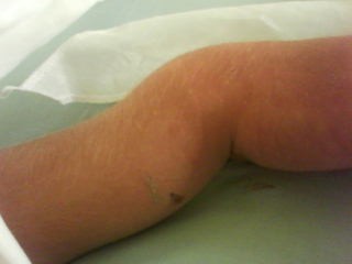 A picture of my left wrist when i broke both of them.