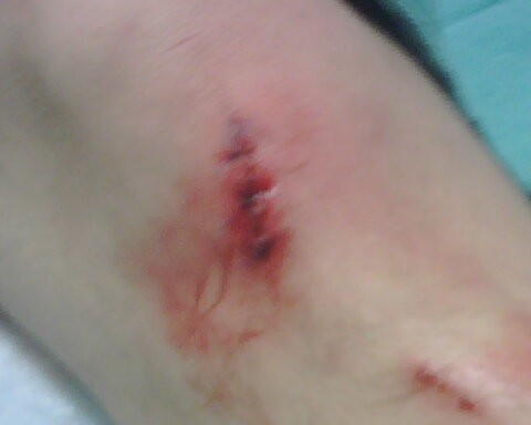 just got it all stiched up 3 here
