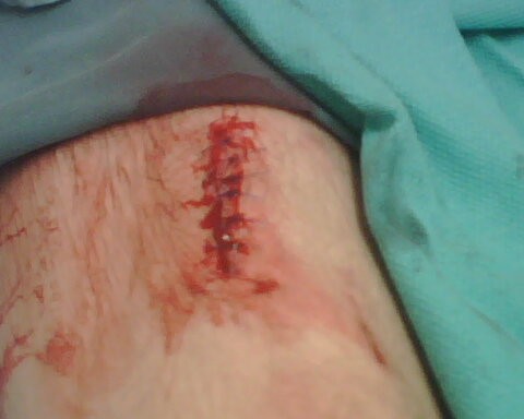 just got it all stiched up 6 here