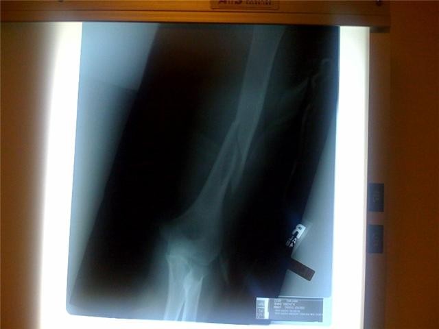 2 weeks after break. 
compund fracture.
going to be be out for about 6-8 months. :(