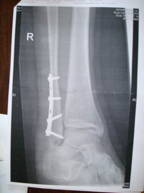 x ray with my new "parts"