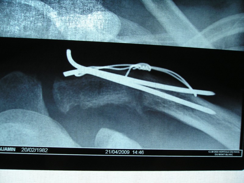 xray after i pulled it apart and twisted the pins