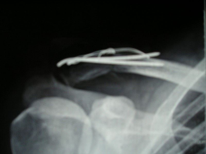 xray 1 month after op