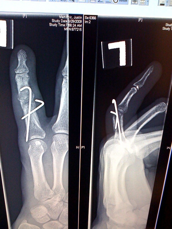 X-Ray of the pins holding my finger together. They just came out today! But i was able to do 2 races with them in there :)