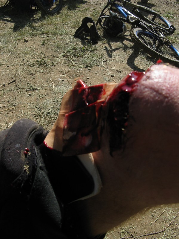 Dirt Corps' Matt Patterson ripped out all the stitches in his knee on while in a race run, he hit the line and I noticed he was sorta white.....we helped him remove his pads and there is what we found- all his stitches from a previous crash- ripped out.