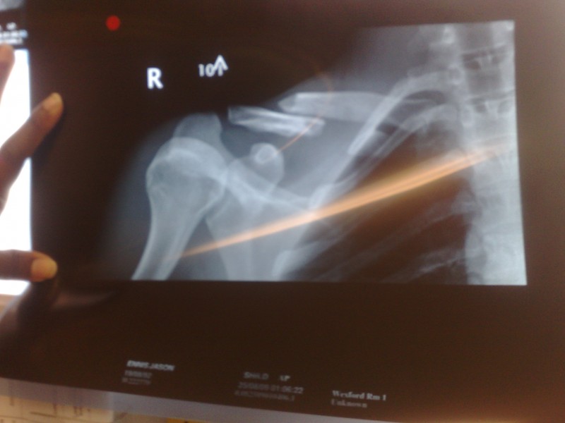 Broken collar bone