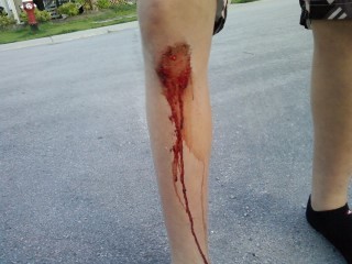 Bloody leg!!