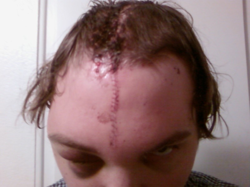 Lots of staples and stiches. Now I wear a helmet whenever I ride.
