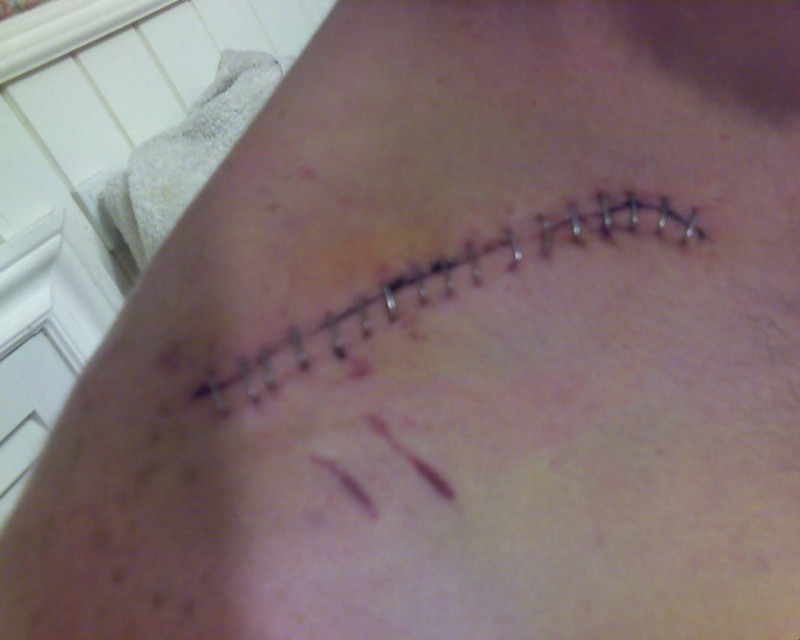 THE AFTERMATH 5 days and 17 staples later collerbone carnage