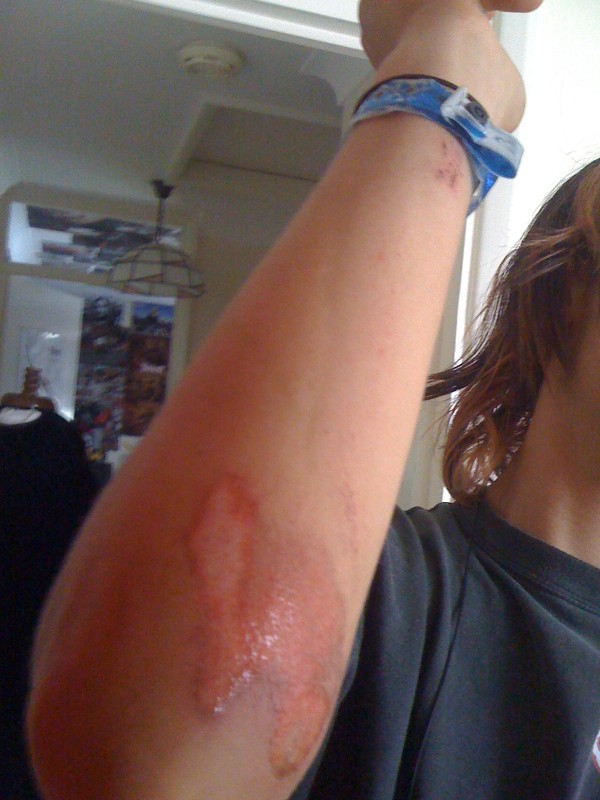 ripd up my elbows and hit my face on the pavement when my fround wheel came off :S