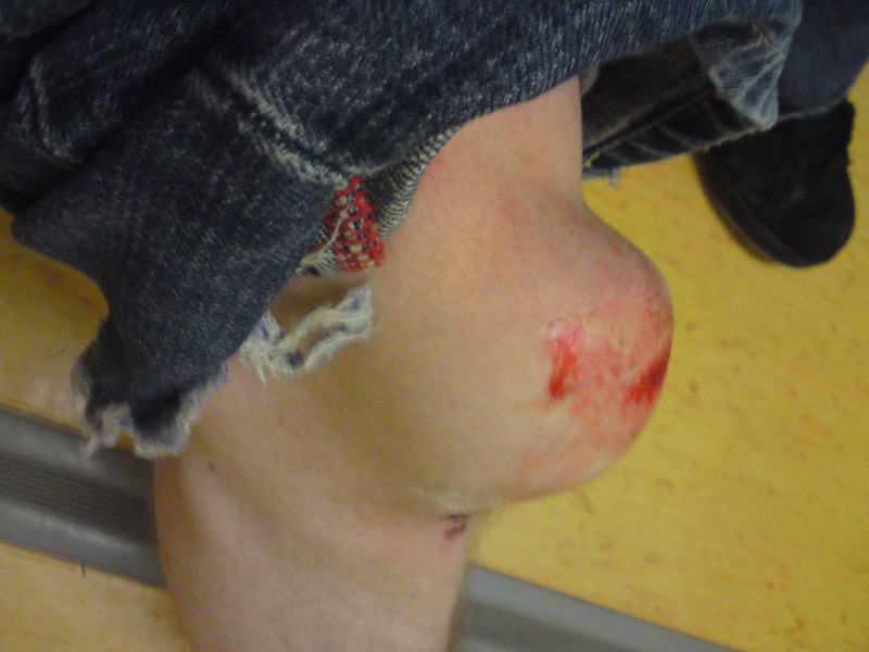 my knee in the hospital - internal bleeding can be fun