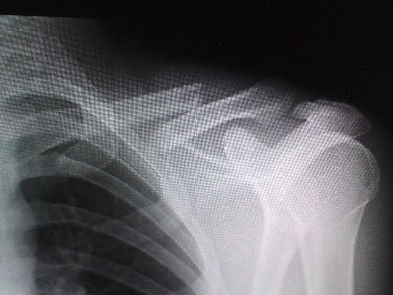 X-ray of my shoulder
