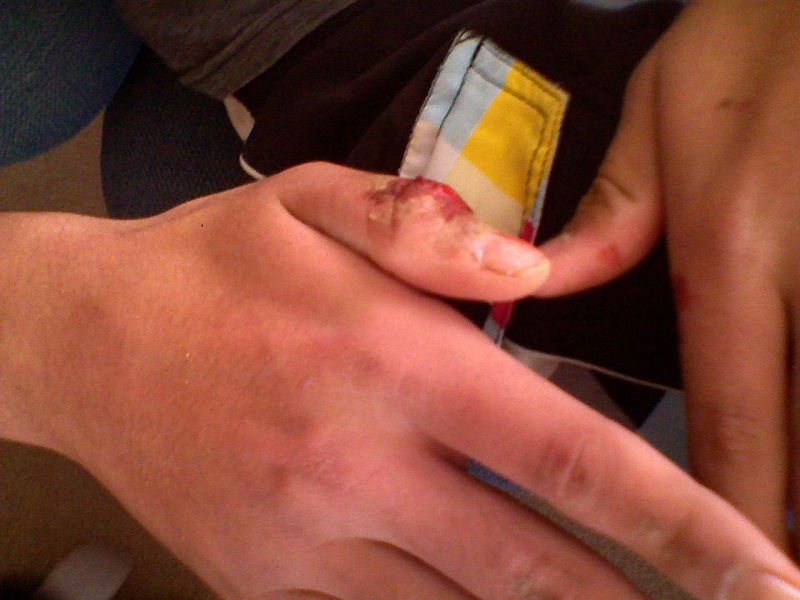 my thumb after falling