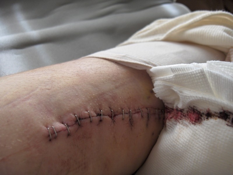 fox knee contest. after surgery from outside in 3.5 inch incision,16 staples,12 suechers to hold tendon to bone fragment that is being held on with 2 screws