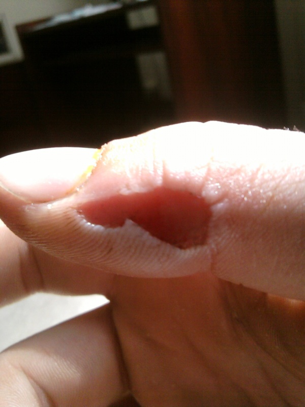hole in my thumb XD