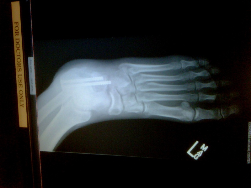 My shattered calcaneous.