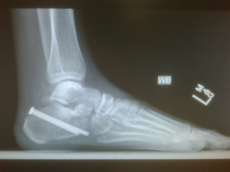 My shattered calcaneous.
