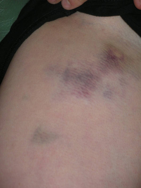 my leg after hanle bar in 'area' from about 2007/08