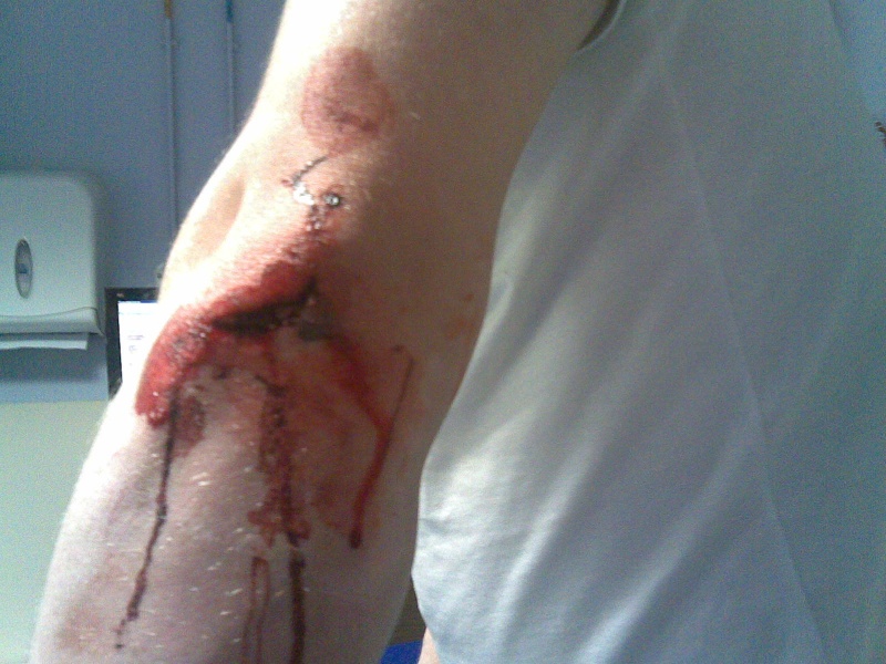 9 stitches
