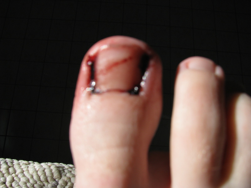 I got my second out patient procedure because of ingrown toenails and this is what my most recent one looked like when I woke up this morning.