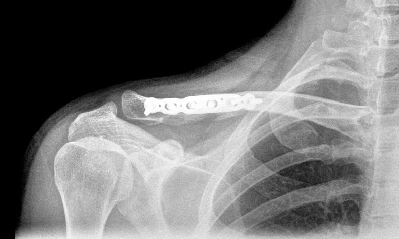 this is what happens when you say: "i'm gonna proper push it this time" on DH track in Wharncliffe.. broken collarbone... can't afford any titanium bike parts? get one installed in you body instead ;)