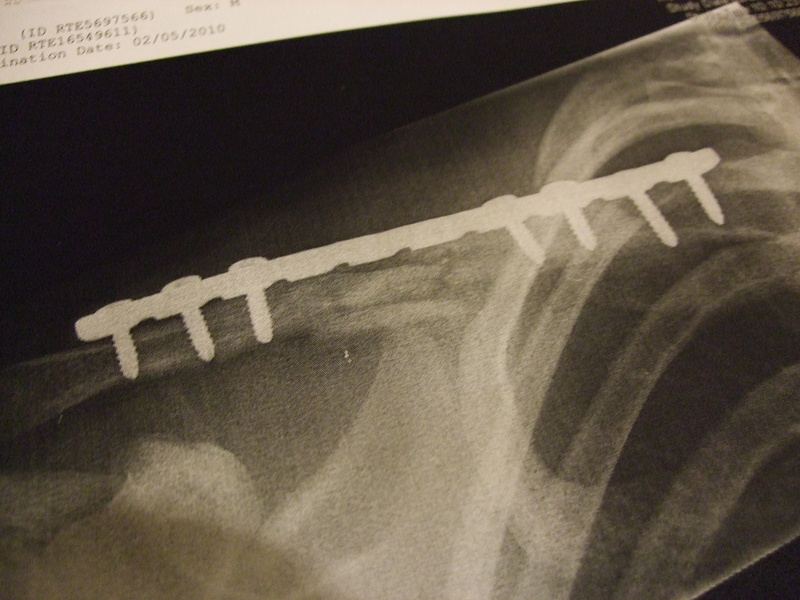 collar bone after the op