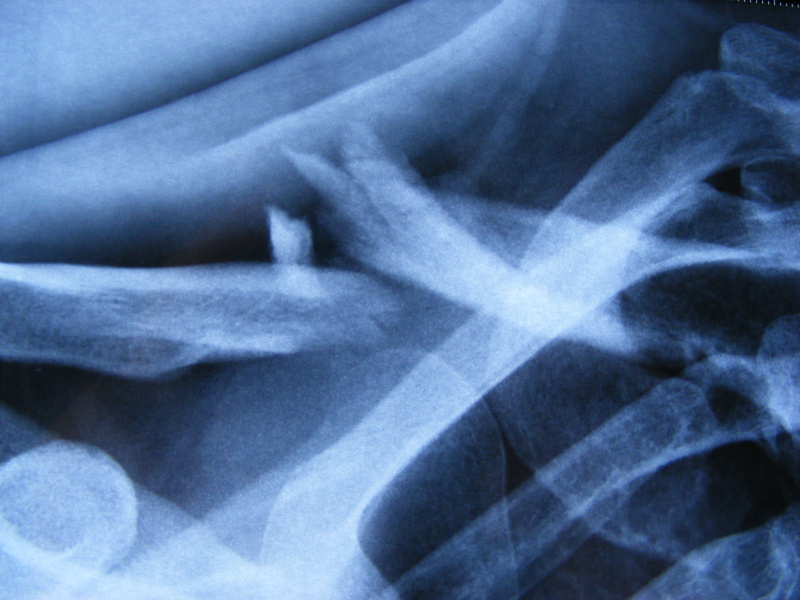 open fracture on my collarbone