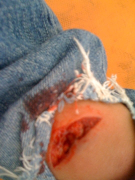 11 stiches from my knee landing on my compression knob on my argyle