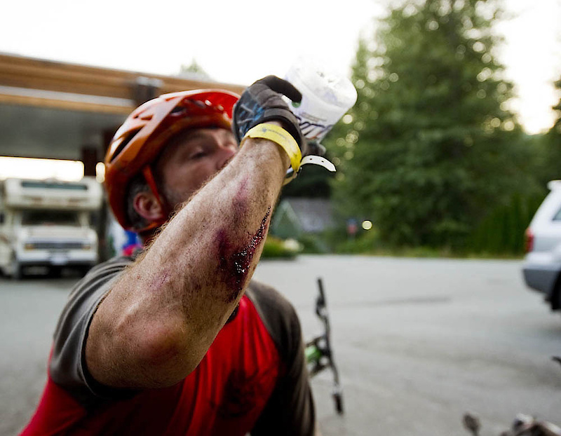 Not even a hamburgered forearm could take away the pleasure of a 5,000 vertical foot PINNER ride down Khyber Pass from Whistler Peak.