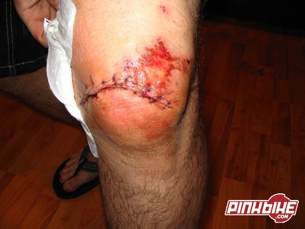 his knee-this happenned the same time the compound fracture of the arm happenned