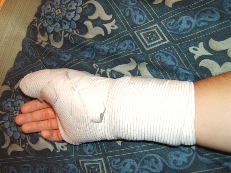 My hand in a cast after crashing on a jump