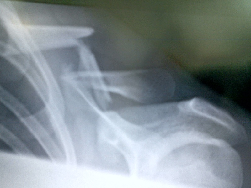 my collar bone broken in 3 places. going in for an op tomorrow