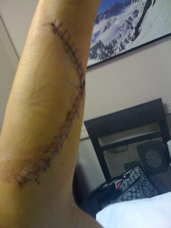 30 stitches and 14 more on top of my wrist